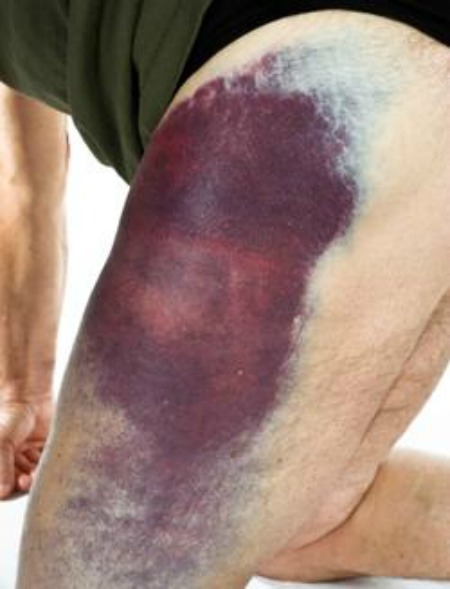 42636-250x327-Deepbruise