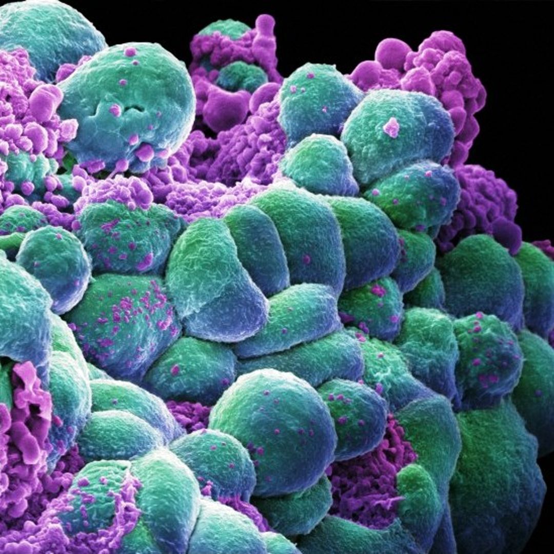 Breast-Cancer-Cells